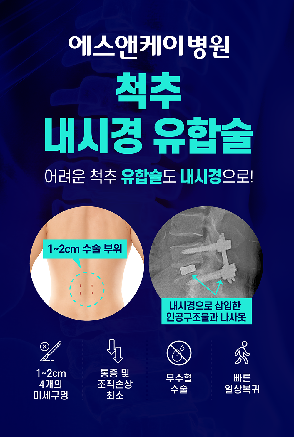 에스앤케이병원, 척추 내시경 유합술